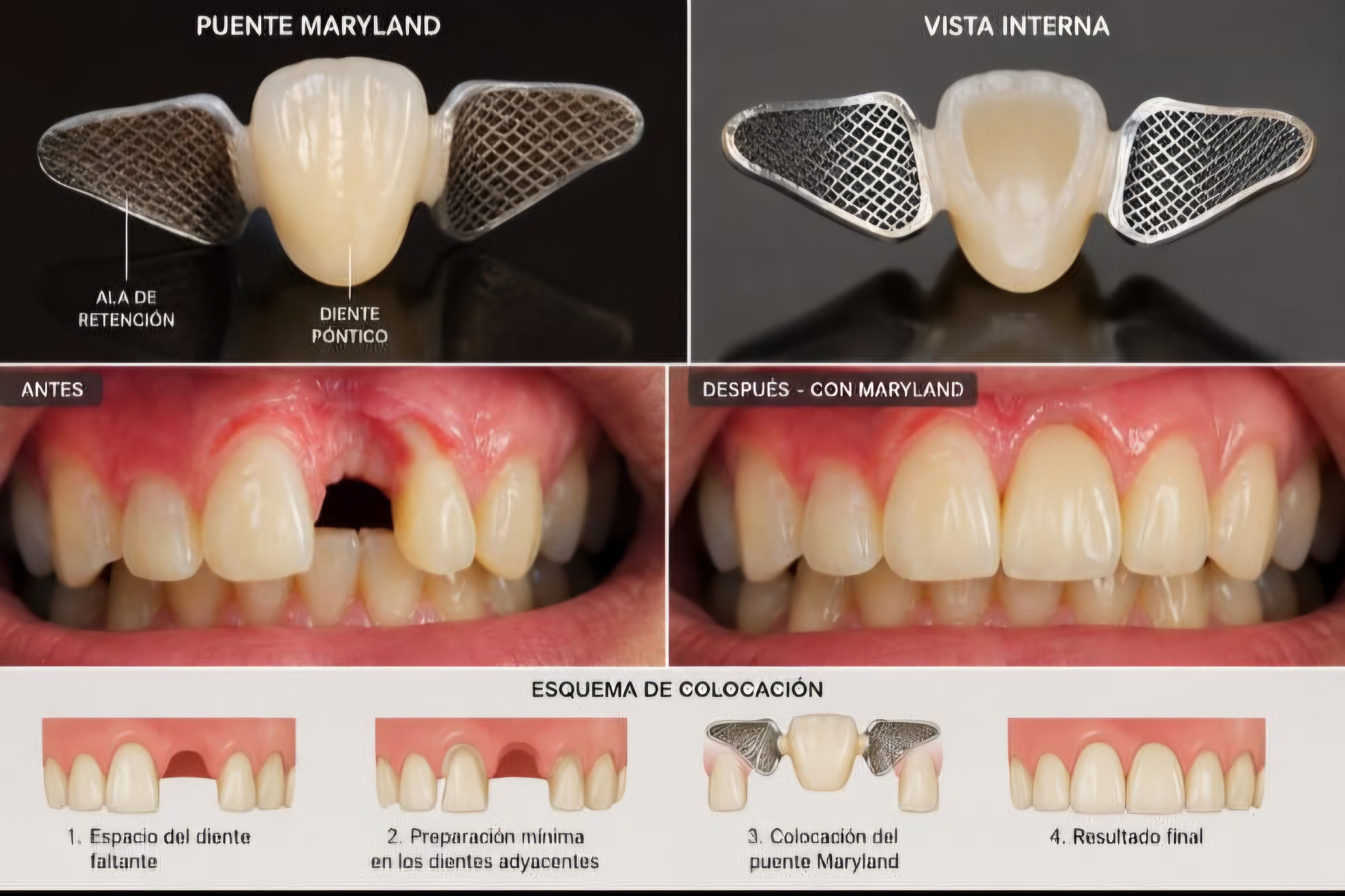 Puente Maryland - Mariland Dental